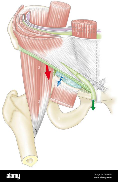 Inguinal Hernia Hi Res Stock Photography And Images Alamy