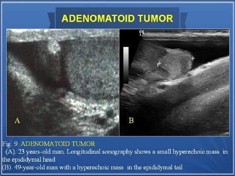 Epididymis Lump Ultrasound