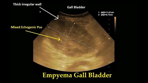 Empyema Gallbladder Ultrasound Case 24 Youtube