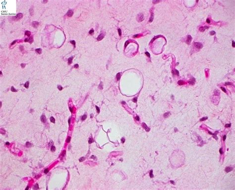 Myxoid Round Cell Liposarcoma Humpath Human Pathology