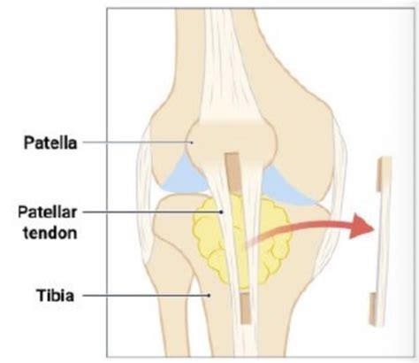 5 1 ACL Injury Treatment Flashcards Quizlet