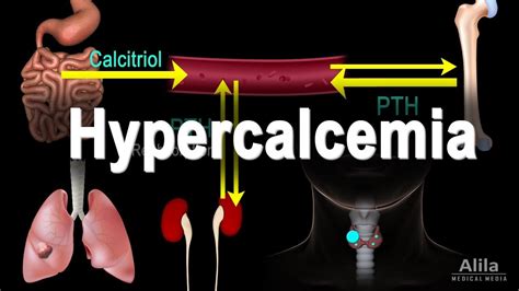 Hypercalcemia Too Much Calcium Animation Youtube