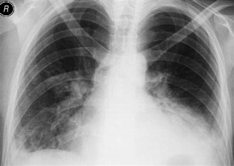 Chest X Ray Of Patient Showing Bilateral Lower Lobe Pulmonary