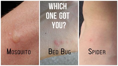 Decode Bites Is It A Mosquito Or Spider Spot The Signs