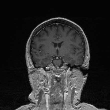 Acoustic Schwannoma Image Radiopaedia Org