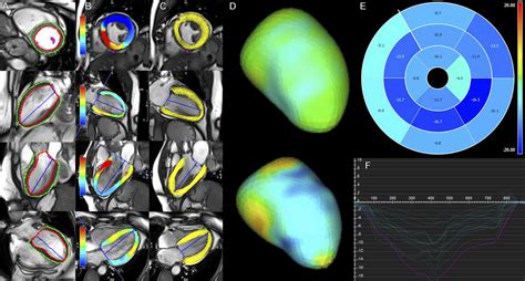 Global Longitudinal Strain Analysis Using Cardiac Mri In Aortic