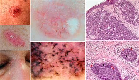 Carcinoma Basocellulare Dermatologia E Venereologia