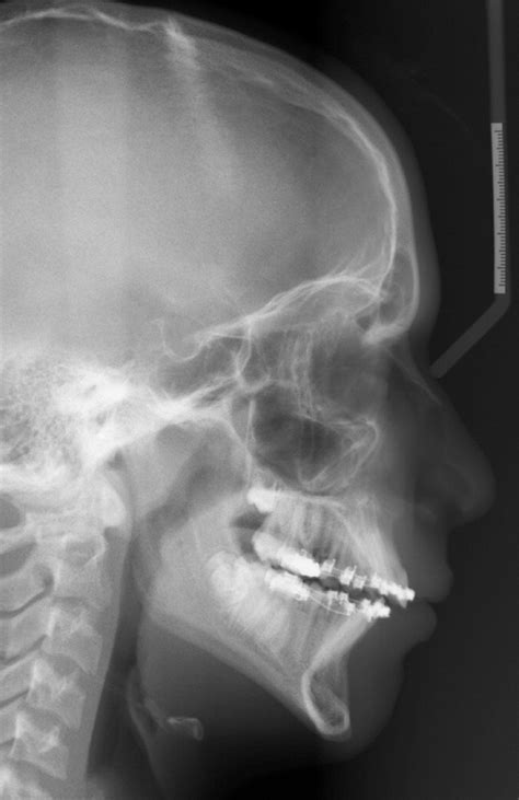 Radiology Of Cleft Lip And Palate Imaging For The Prenatal Period And