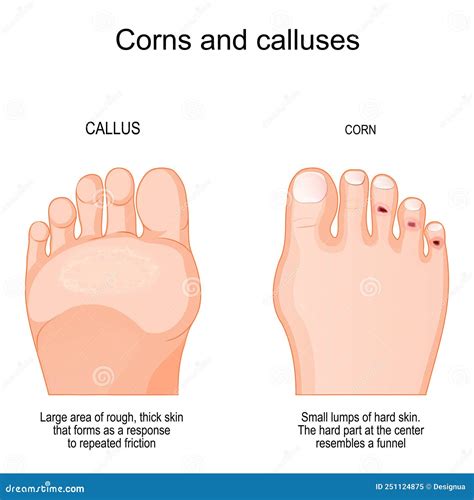 Feet Callus Or Corn. Swollen Skin With Rough, Yellowing Patch Of Lumpy