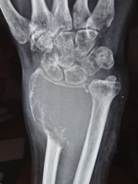 Giant cell tumours (GCT) of bone (also known as a osteoclastoma) are ...