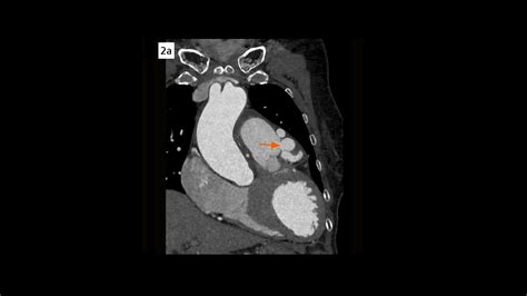 Complex Coronary Artery Fistula Siemens Healthineers Usa