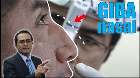 RinoplastÍa EstÉtica Cerrada ️ Giba Nasal Grande Caso Real 👃 Dr Percy