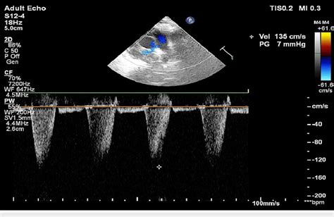 Color Doppler Ultrasound Of The Right Radial Artery Distal To The Download Scientific Diagram