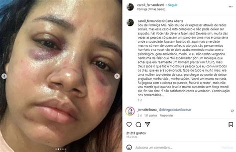 Mulher Agredida Pelo Ex Marido E Exp E Fotos E Relato Na Internet