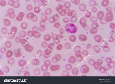 Neutrophil Blood Smear Under Microscopy Stock Photo 1120072277 ...