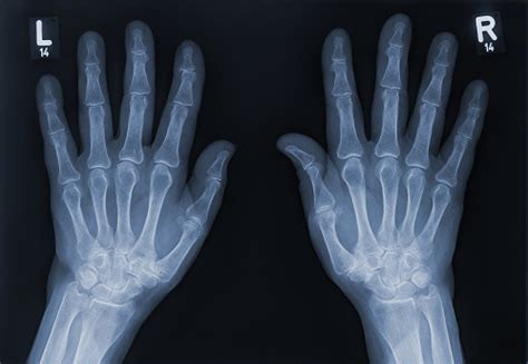 Xray Of A Left Hand And Right Hand Stock Photo - Download Image Now - iStock