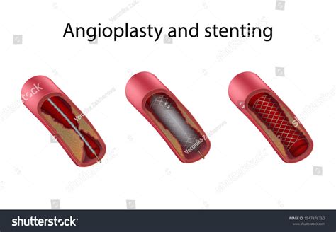 Angioplasty Stenting Stages Medical Anatomy Illustration Stock