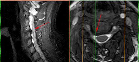 Terapia Del Dolore Interventistica Vertebrale Ozonoterapia Trapani