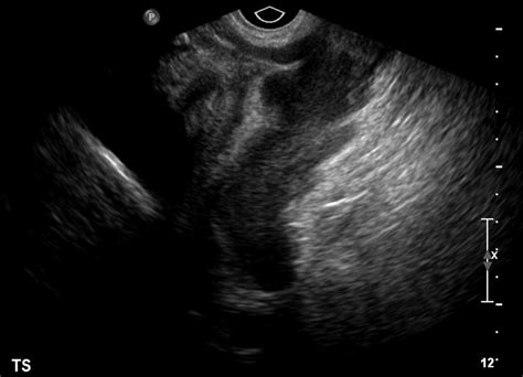 Imaging Features Of Myxoid Soft Tissue Tumours Clinical Radiology