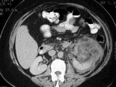 Lymphangioleiomyomatosis Imaging And Diagnosis Practice Essentials