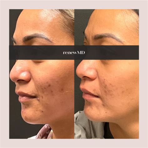 Microneedling With Prp Platelet Rich Plasma Using Skinpen Renewmd