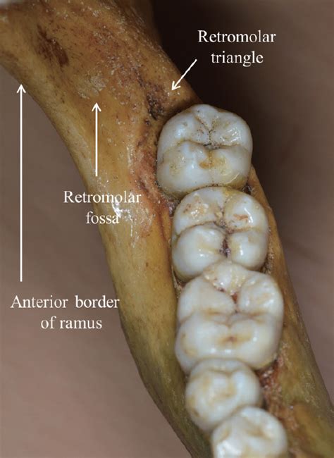 Retromolar Pad Anatomy