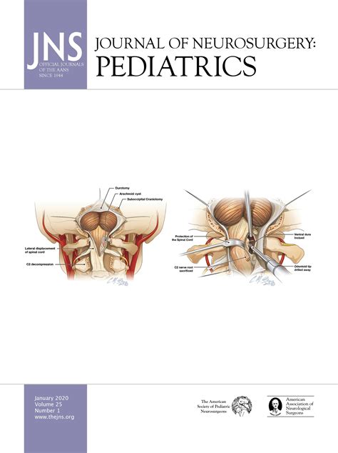 Yolk Sac Tumor Sacrococcygeal