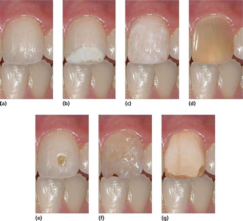 Developmental Defects Of The Dental Hard Tissues And Their