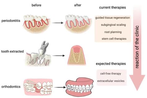 Research Advances On Stem Cell Derived Extracellular Vesicles Promoting