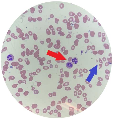 B12 Deficiency Smear