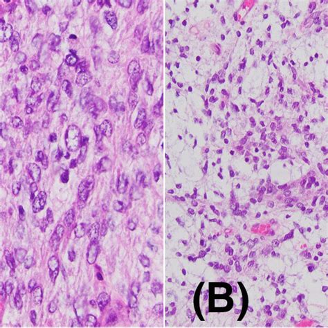 CNS Fibroblastic Tumor With NTRK Rearrangement A Spindle Cell