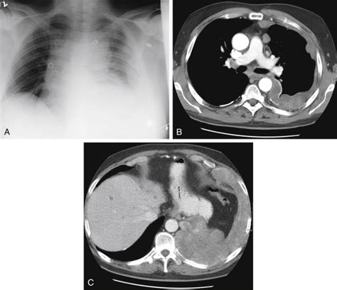 Pleural And Subpleural Opacities Radiology Key