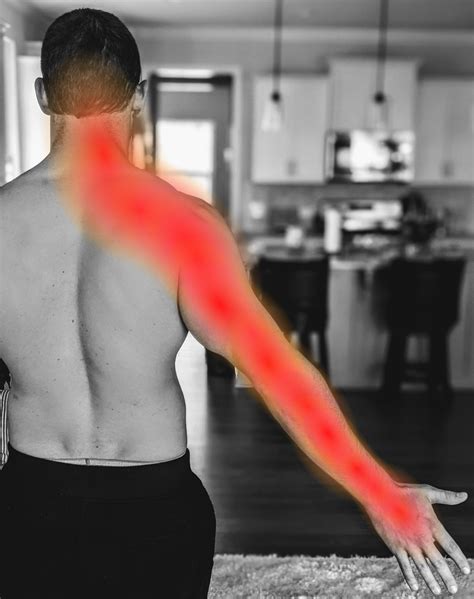 The Authoritative Guide to Cervical Radiculopathy (and 8 Effective