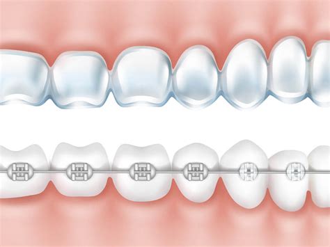 Benefits Of Invisalign Over Traditional Braces