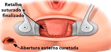 Fistula Anal Colonoscopia Coloproctologia Endoscopia