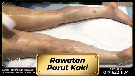 Rawatan Parut Kaki Laser Light Skin Centre YouTube