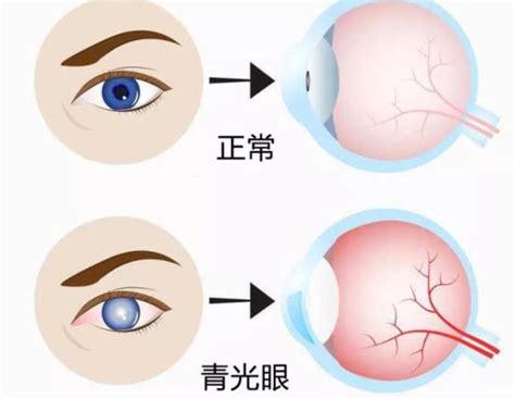 認識青光眼，警惕視力被「偷走」！一文帶你了解這個「視力殺手」 每日頭條