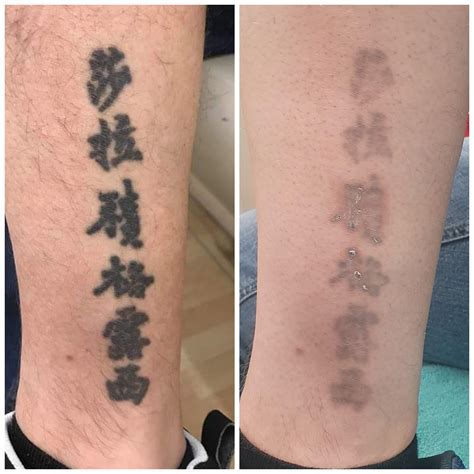 Tattoo Removal Progress After 25 Laser Sessions At 5 Week Intervals