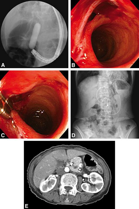 Endoscopic Closure Of A Distal Common Bile Duct Perforation Caused By