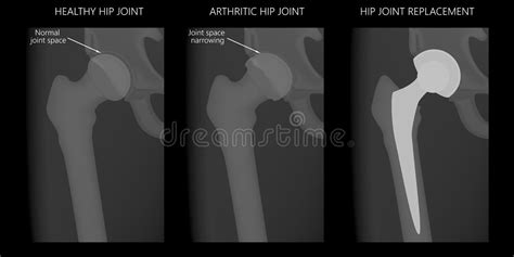 Hip Arthroplasty Stock Illustrations – 162 Hip Arthroplasty Stock ...