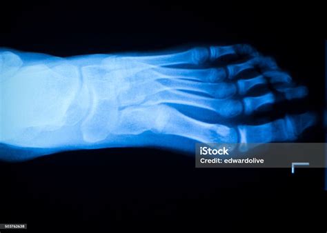 Foot And Toes Injury Xray Scan Stock Photo - Download Image Now - Adult, Anatomy, Ankle - iStock