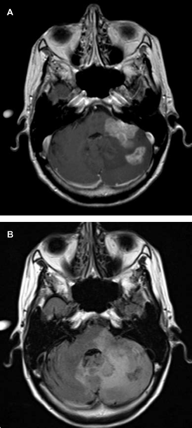 A Axial T Weighted Postgadolinium Contrast Enhanced Magnetic