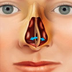 Repair Of Septal Perforation Raleigh Capitol Sinus Allergy Center