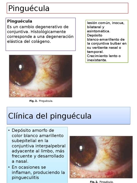 Pinguécula Y Pterigion Pdf Especialidades Medicas Medicina Clinica