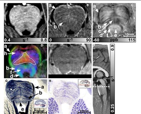 Figure From High Resolution Mr Imaging Of The Human Brainstem In Vivo