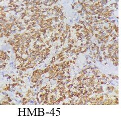 Tumor Cells Arranged In Nest And Fascicles Separated By Fibrous Septa