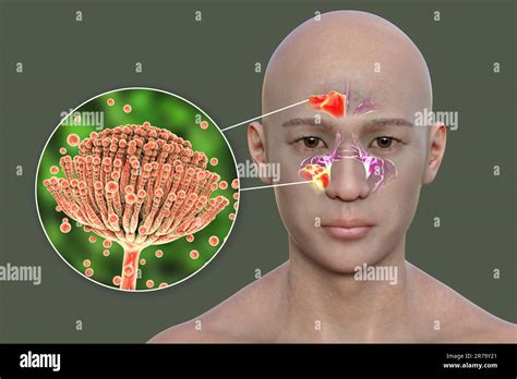 Aspergillus Fungi As A Cause Of Sinusitis 3d Illustration Showing