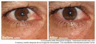 Medical Treatment Pictures-for Better Understanding: Pterygium Excision ...