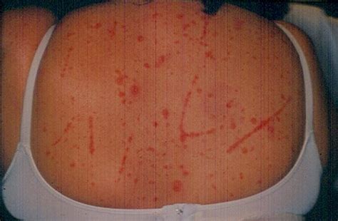 Psoriasis Psoriasis Keobner Phenomenon Picture Hellenic