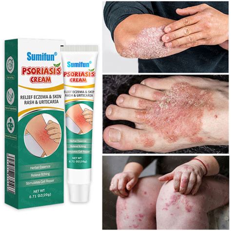 Psoriasis Eczema Cream Antibacterial Anti Itching Herbal Dermatitis